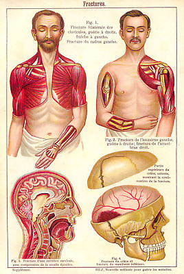 #ad Vtg French Anatomical Bone Fracture Trauma Chart #1 NEW Fine Art Print Arm Head $10.99