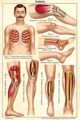 #ad Vtg French Anatomical Bone Fracture Trauma Chart #2 NEW Fine Art Print Legs $6.99